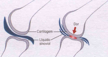 Articulação saudável e articulação com osteoartrite
